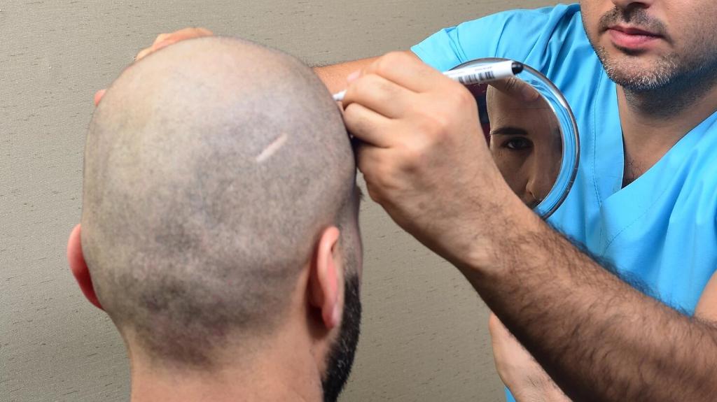 Restauración del cabello en Turquía