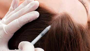 Haarmesotherapie