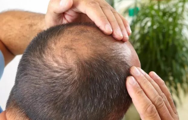 Die Gründe und Behandlung von Haarausfall