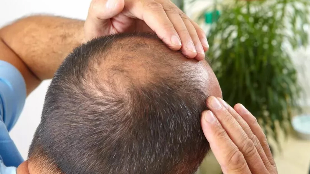 Die Gründe und Behandlung von Haarausfall